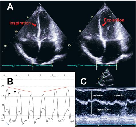 what is abnormal septal motion